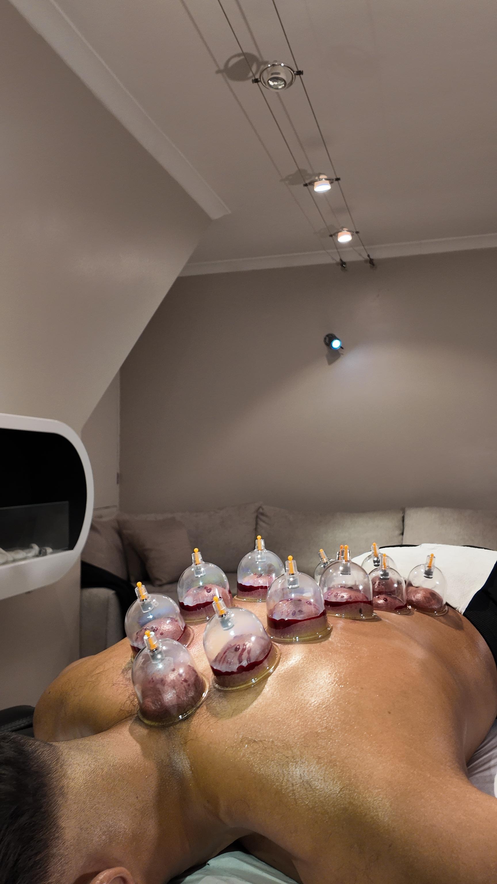 Hijama package clean cupping setup