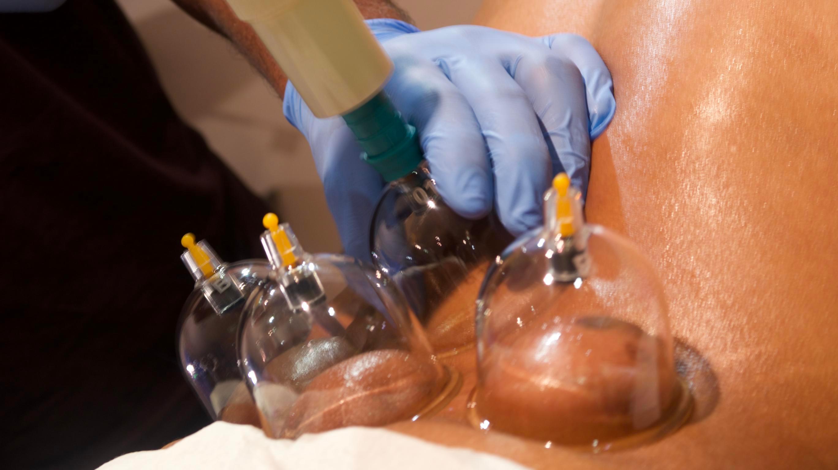 Fire cupping and essential oils package setup